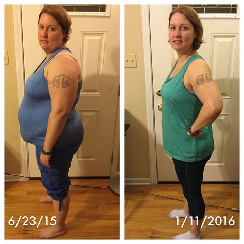 Gastric Surgery Before And After Pictures Gastric Bypass