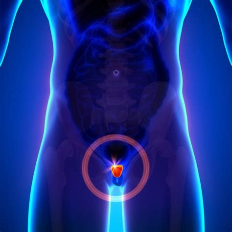 active surveillance required after prostate cancer focal