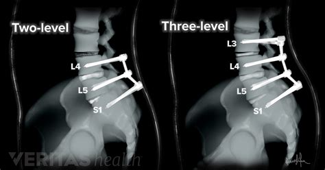 multilevel spinal fusion    pain