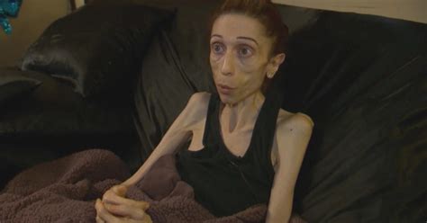 california woman hopes to come to denver for anorexia treatment cbs