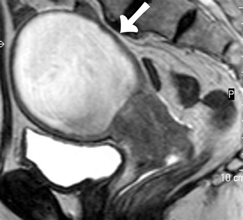 mr imaging of the uterine cervix imaging pathologic correlation