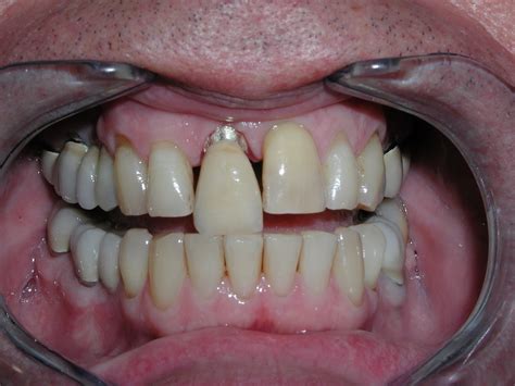 sbo dental laboratory  zirconia crowns   pfm