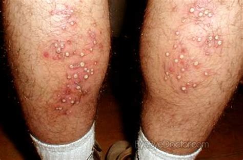 hot tub rash pictures symptoms treatment cure causes remedy