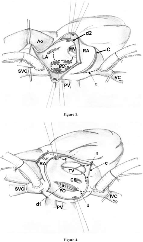 figure   mitral valve surgery  transseptal  septal superior