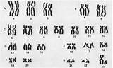 Karyotype Cromosomi System Chromosomes Chromosome Karyotyping Cariotipo Umano Trisomy Genes sketch template