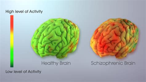 schizophrenia and bipolar disorder the overlap scientific animations