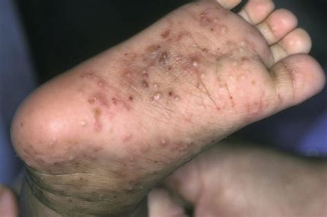 limited examination detects scabies with high sensitivity dermatology