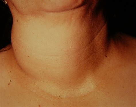 neck  pics  surgery