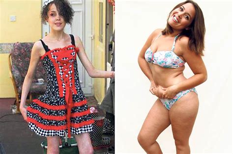 Anorexic Puts On Five Stone And Gains 39 000 Online Supporters Daily Star