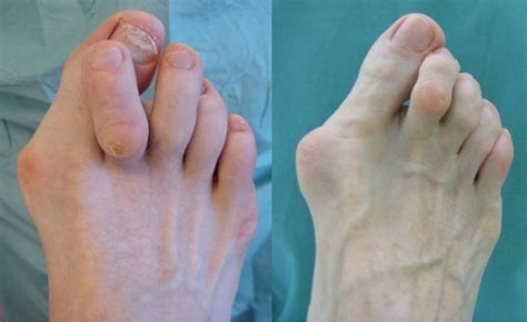 hallux valgus treatment  recovery sincerus orthopaedics