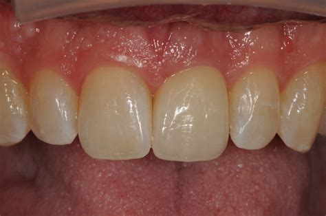 showcase single front tooth implant dr gennero