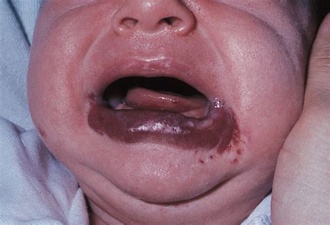 hemangiomas of infancy clinical characteristics morphologic subtypes and their relationship