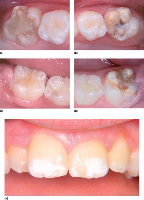 20 Developmental Defects Of The Dental Hard Tissues And Their