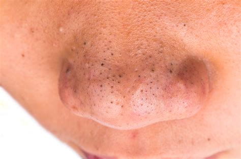 blackhead treatments