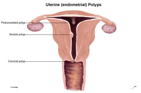 endometrial polyp reproductive medbullets step
