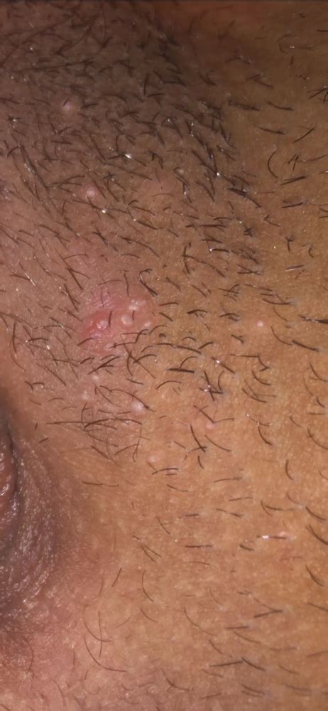do genital warts grow hair sexual health forums patient