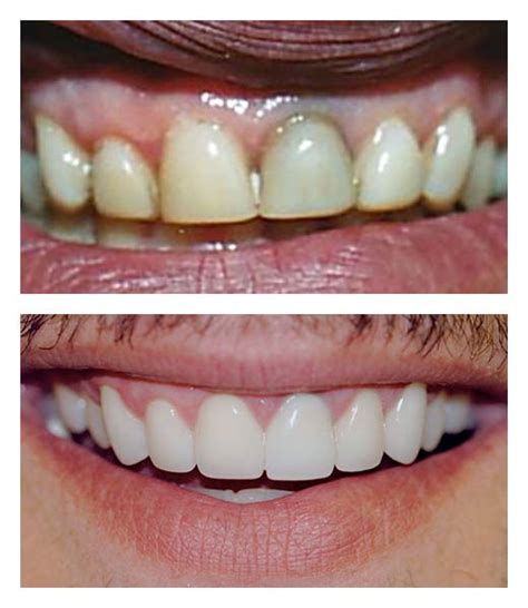 Dental Veneers Before And After Bartholomew Dentist