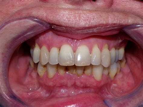 partial  full denture  dr dove dentistry barrie