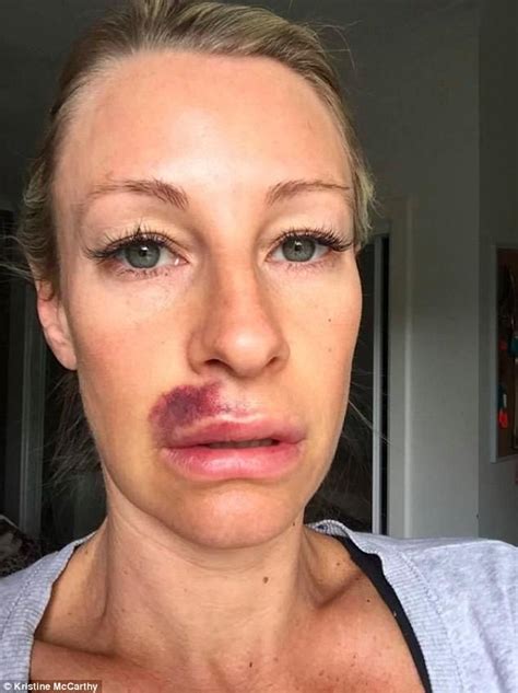 sydney mother s lip filler injection horror daily mail online