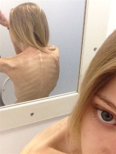 Thinspiration Selfies Almost Killed Me Anorexia