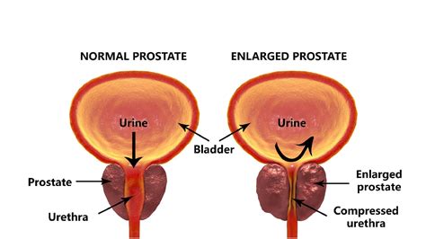 Prostate Cancer In Men Prostate Cancer Cases Symptoms And Prevention