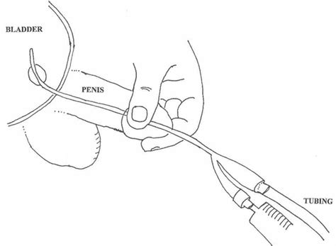 Foley Catheter Insertion Care Removal Use And Types