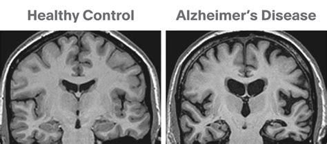 Brain Imaging For Psychiatrists Part 2 Structural Static Measures