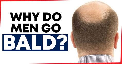 why do men go bald williams integracare clinic