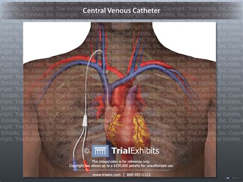 central venous catheter trialexhibits inc