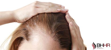 Female Pattern Baldness Beverly Hills Hair Restoration