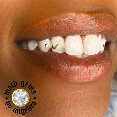 permanent gold teeth   abevegedeika