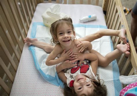 Conjoined Twins Prepare For Separation Surgery At Stanford Hospital