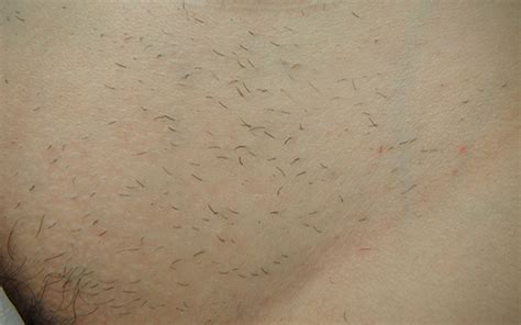 Before And After Hair Removal Results Clhr