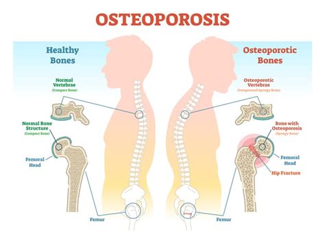 osteoporosis treatment best natural treatment with diet injection