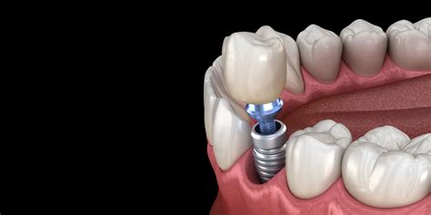 Single Dental Implants Abilene Tx Dentist Leedy Dental