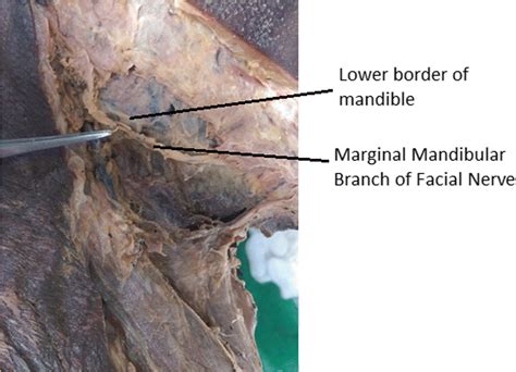 preserving the marginal mandibular branch of the facial nerve during submandibular region