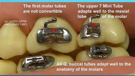 queen series mini buccal tubes  molar ukorthodontic