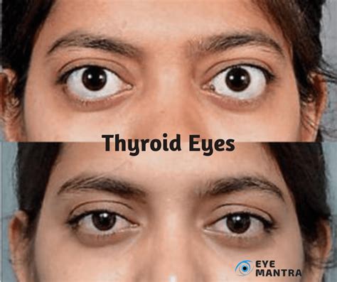 thyroid eye disease risks symptoms  treatment eyemantra