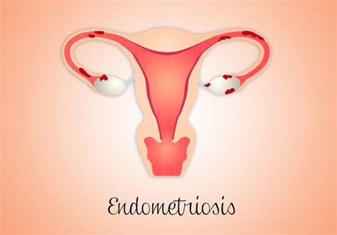 qué es la endometriosis y cómo afecta la fertilidad