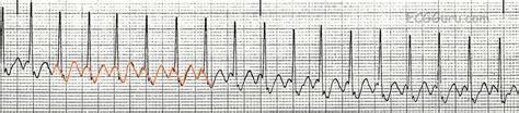 Sinus Tach Or Svt 4 Clues To Tell The Difference