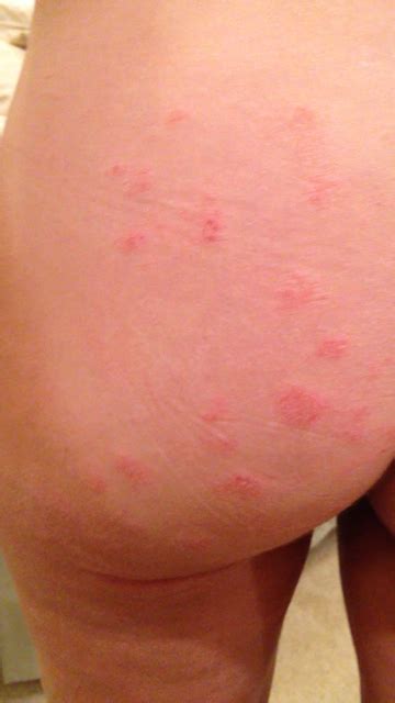 butt rash pictures sex movies pron