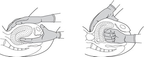 7 Bi Manual Compression Of The Uterus Download Scientific Diagram