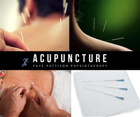 Acupuncture Faye Pattison Physiotherapy Ltd