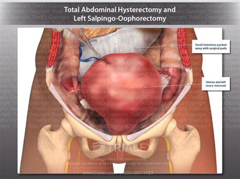 Total Abdominal Hysterectomy And Left Salpingo Oophorectomy Tri