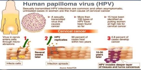 Human Papillomavirus Infection Diagnosis Treatment And Prevention