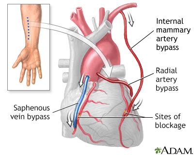 depth reports heart bypass surgery series