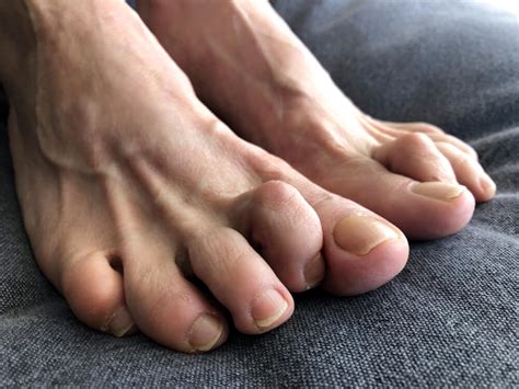 Hammer Toe Relief At Appalachian Foot And Ankle Associates