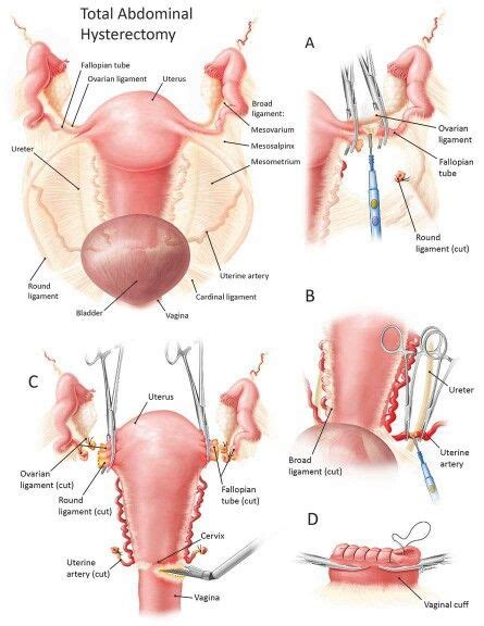 total abdominal hysterectomy hysterectomy hysterectomy