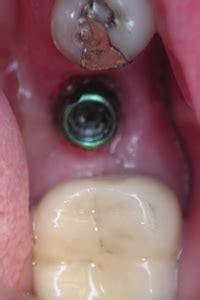 dental implant abutments  dr