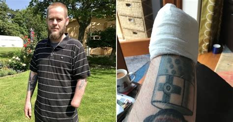 Dj Loses Hand To Flesh Eating Disease After Getting Tiny Scratch